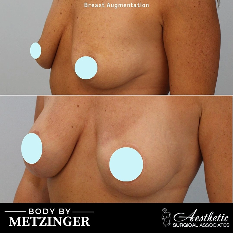Breast augmentation before and after, oblique view showing enhanced shape and fullness