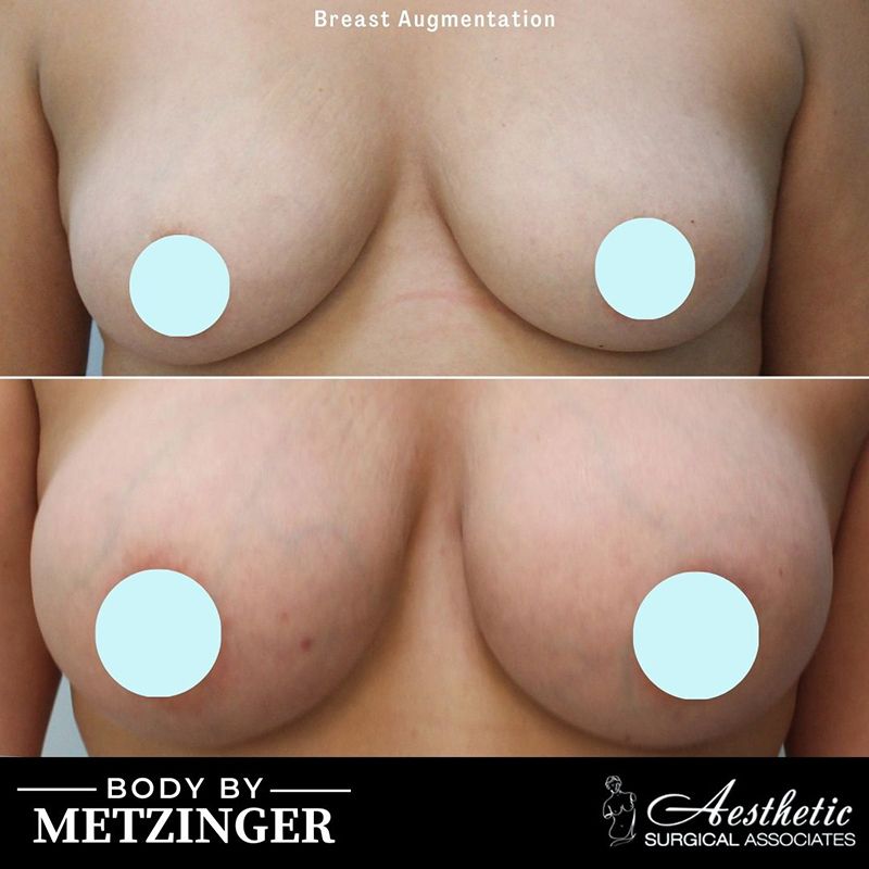 breast_augmetation_case17