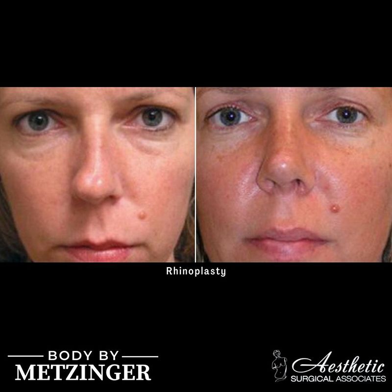 Before and after frontal face view showing rhinoplasty results with refined nose profile
