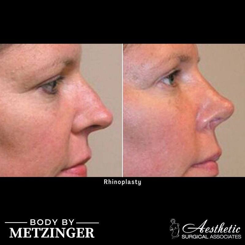 Before and after profile view of rhinoplasty results showing balanced nose proportion