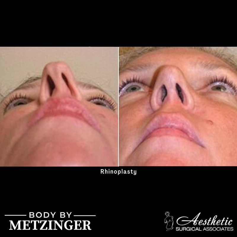Before and after underview of rhinoplasty results showing refined nasal structure
