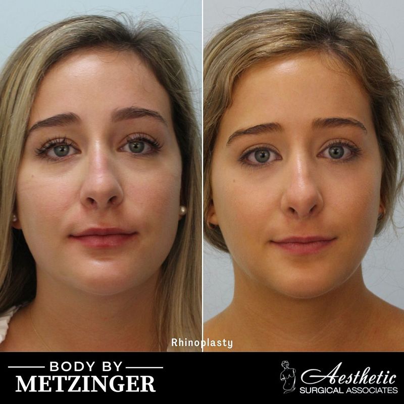 rhinoplasty_case9