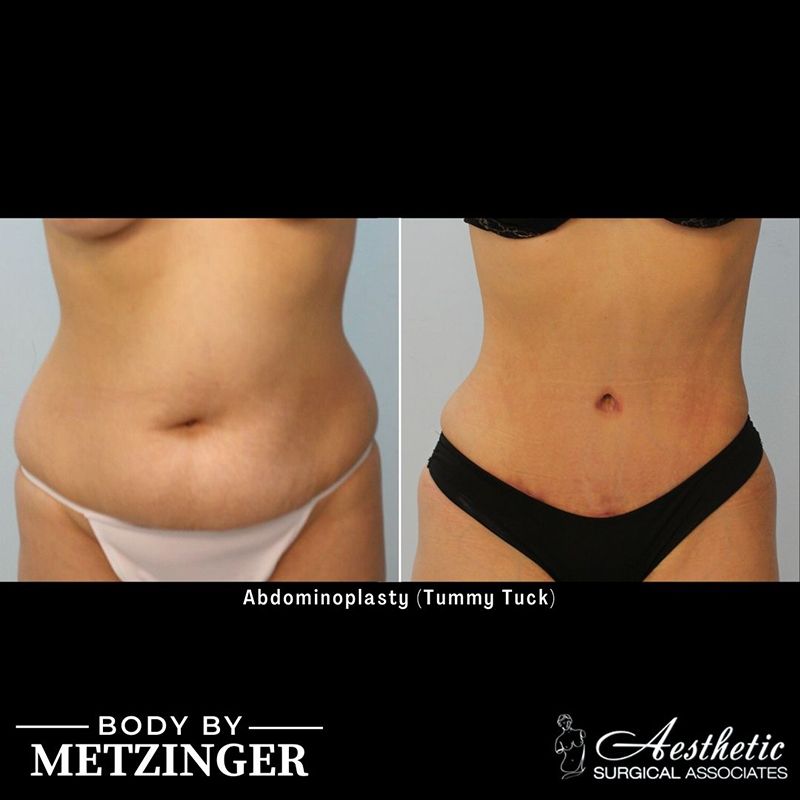 tummy_tuck_case10