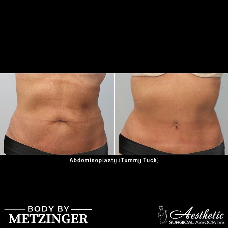 tummy_tuck_case3