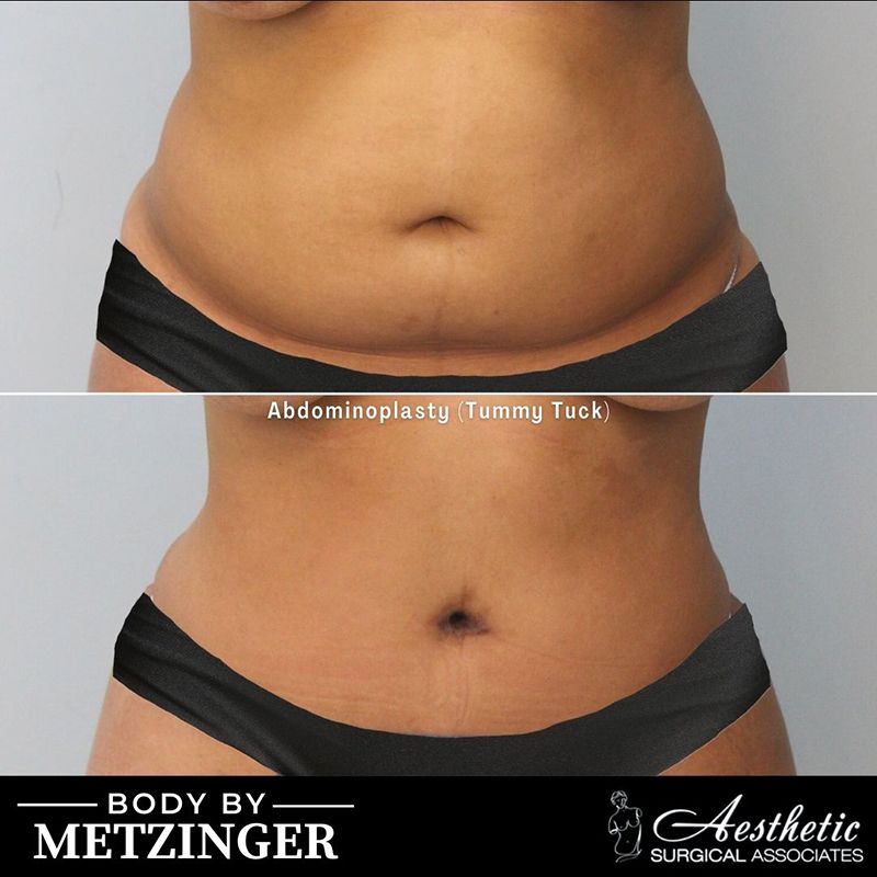 Before and after abdominoplasty case showing reduced abdominal laxity and improved contour