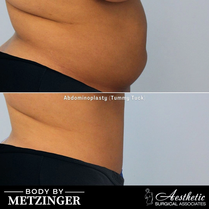 Before and after abdominoplasty showing patient's side profile with tightened abdominal skin