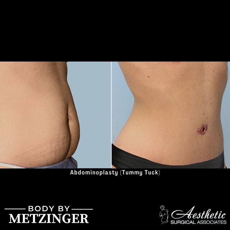 tummy_tuck_case8