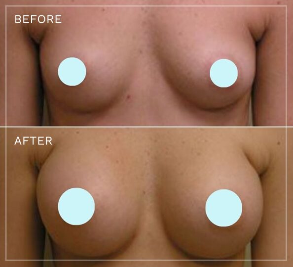 Before and after breast augmentation comparison with privacy circles