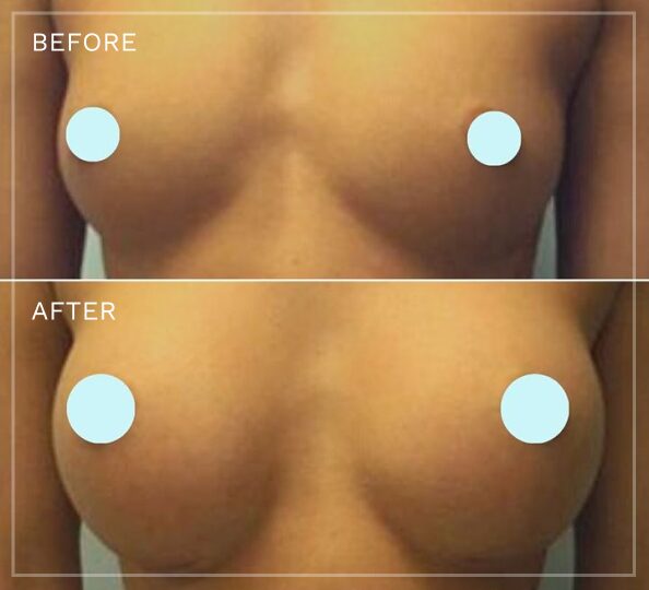 Breast augmentation before and after comparison with patient privacy circles