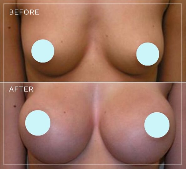 Breast augmentation before and after comparison with patient privacy circles