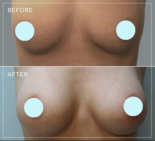 Breast augmentation before and after comparison with patient privacy circles