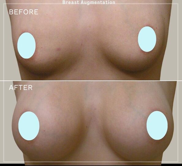 Breast augmentation before and after comparison with patient privacy circles