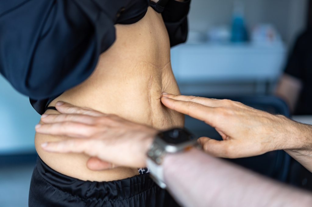 Tummy Tuck for Diastasis Recti: How Surgery Repairs It Banner