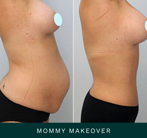 Before and after mommy makeover showing reduced abdominal laxity from side view