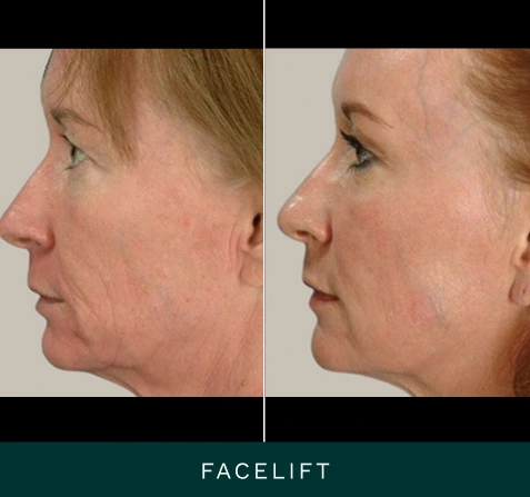 Before and after facelift showing improved facial contours from side profile