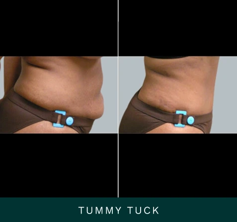 Before and after tummy tuck showing reduced abdominal contour from side view