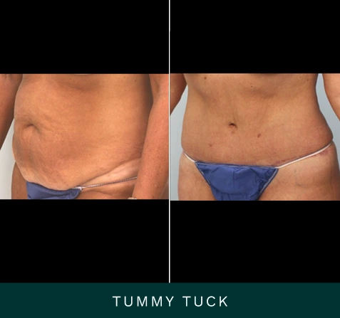 Before and after abdominal comparison showing tummy tuck results