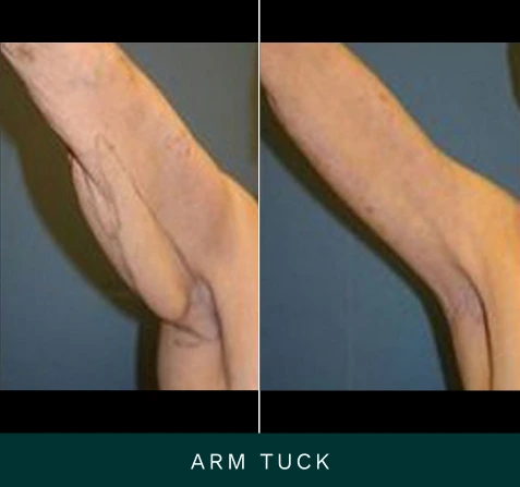 Before and after side views of arm tuck procedure results