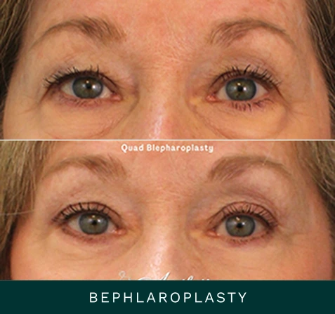 Before and after blepharoplasty showing reduced under-eye hollowing and puffiness