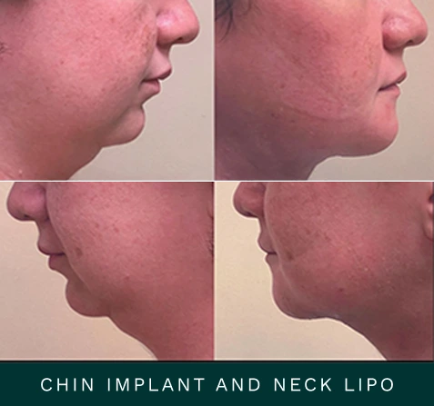 Before and after profile views showing chin implant and neck liposuction results