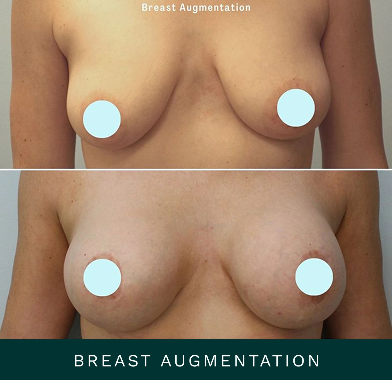 Breast Augmentation before-and-after comparison with text label