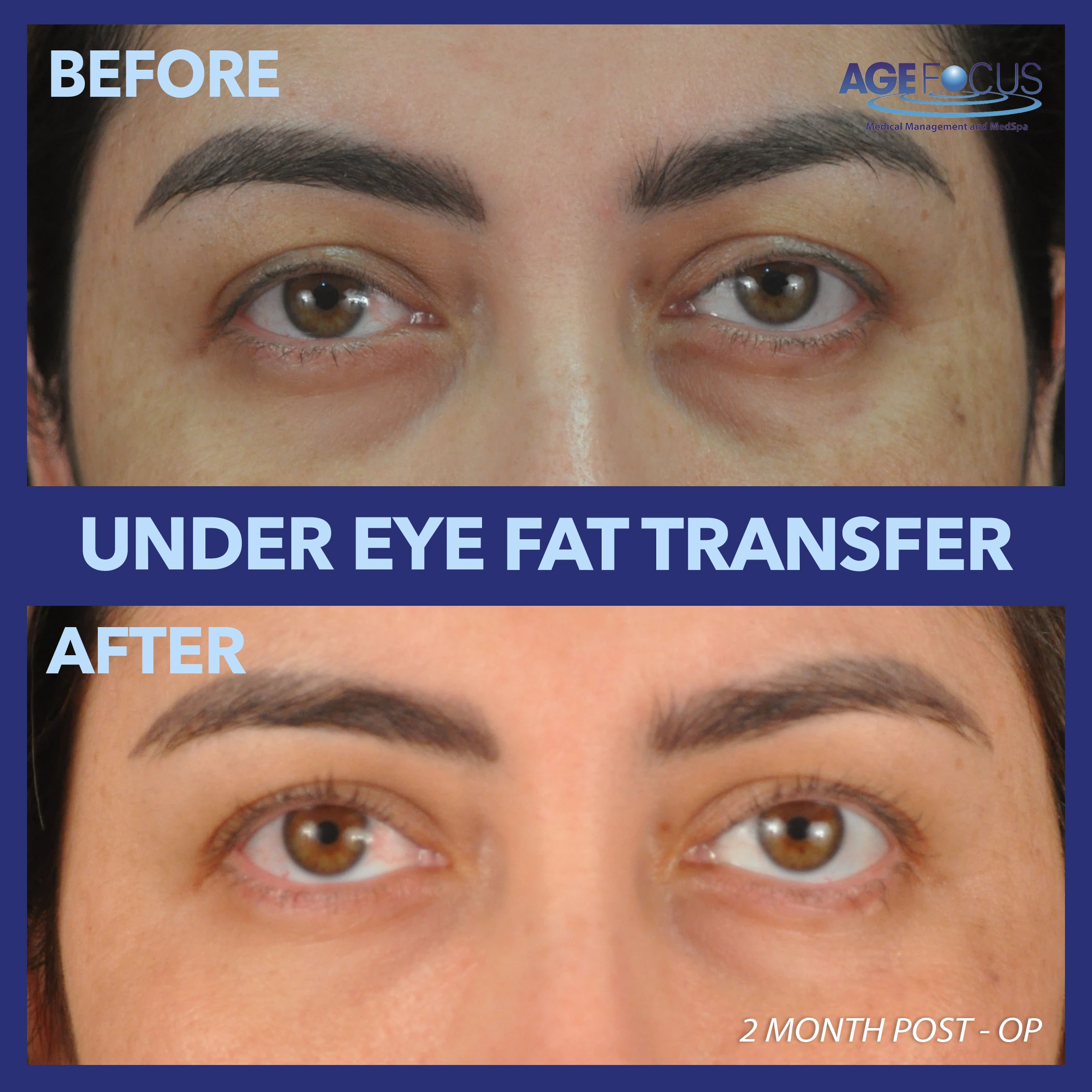 HELEN EYE FAT TRANSFER