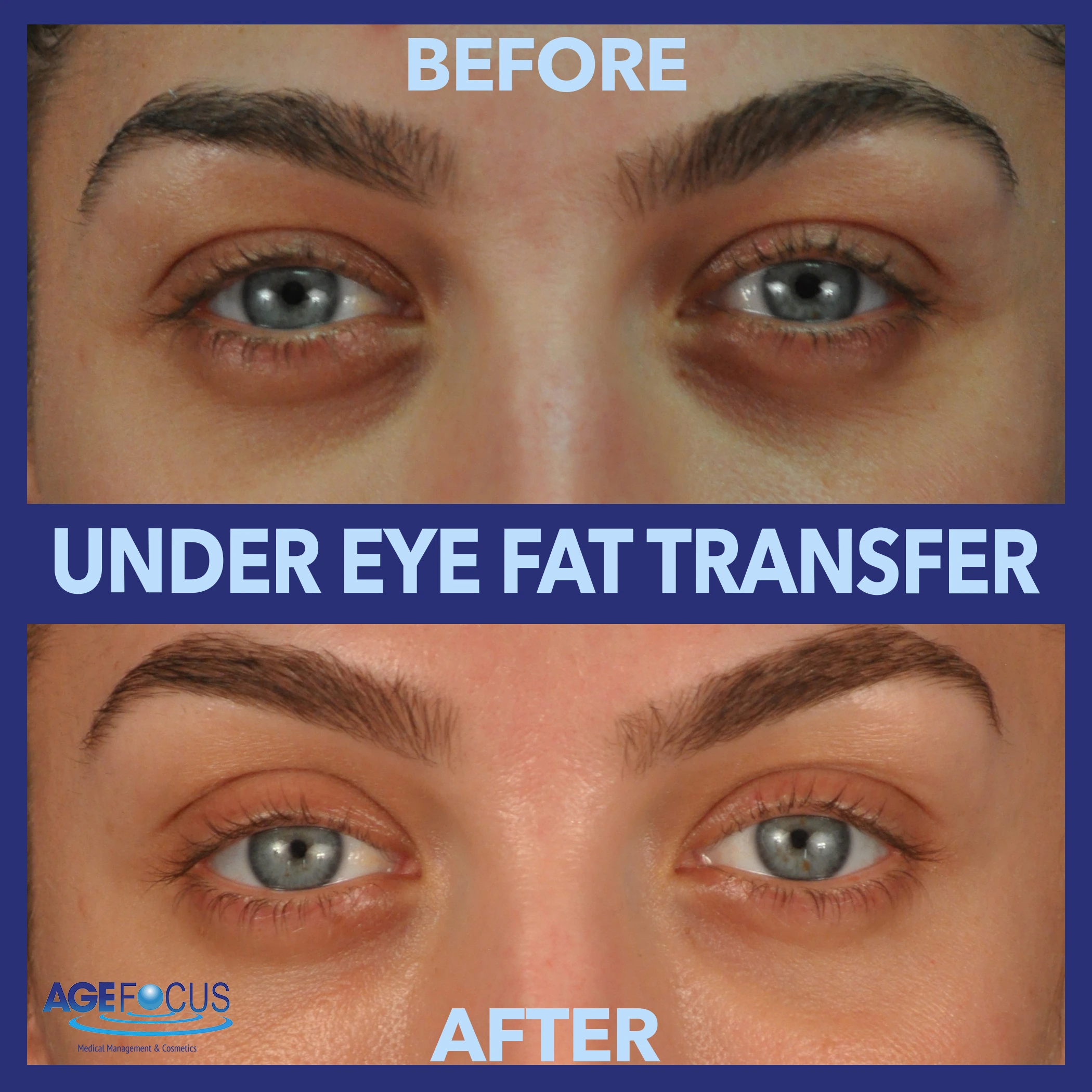 UNDER EYE B&A