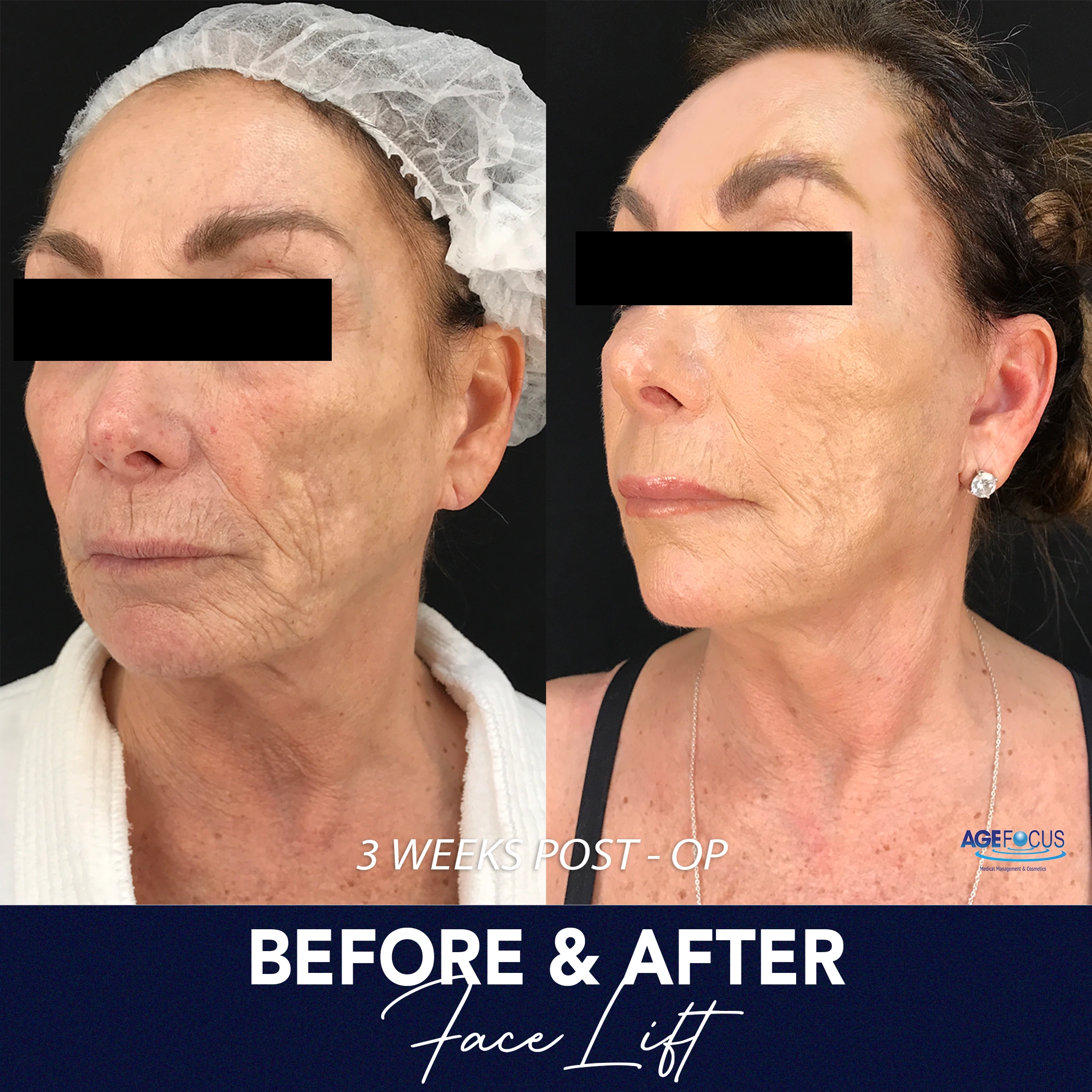 faceliftkathy