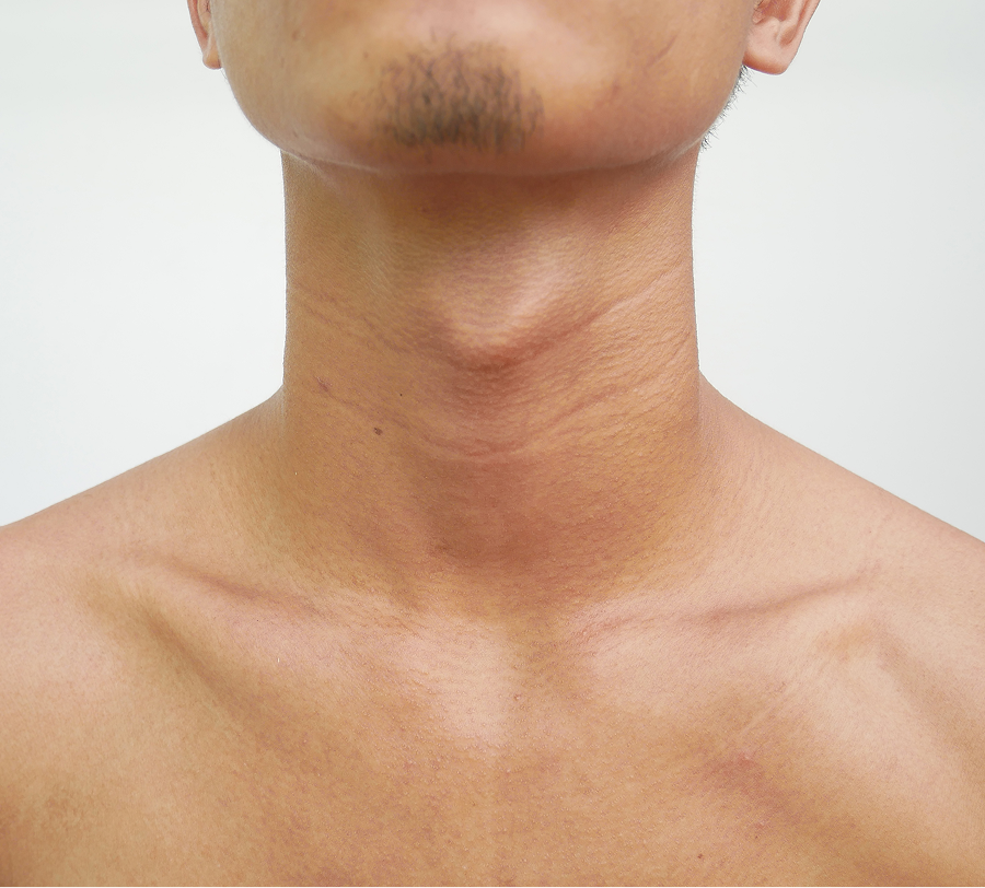 Goiter Care in Atlanta, GA and Tampa, FL Banner