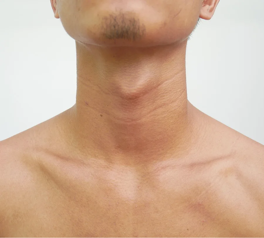 Goiter Care in Atlanta, GA and Tampa, FL Banner