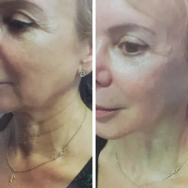 Face and neck-11.1