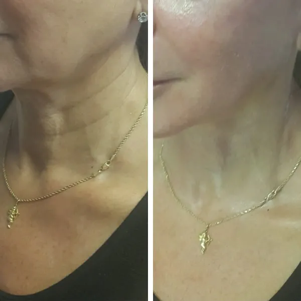 Face and neck-11.2