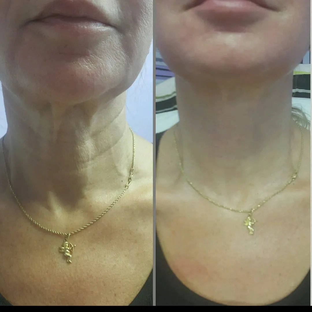 Face and neck-11