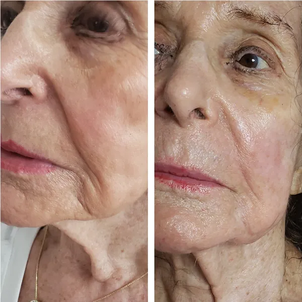 Before and after comparison of face and neck showing reduced wrinkles and improved skin texture