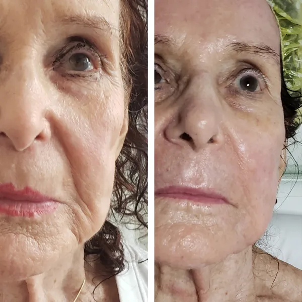 Before and after comparison of face and neck showing smoother skin and diminished fine lines