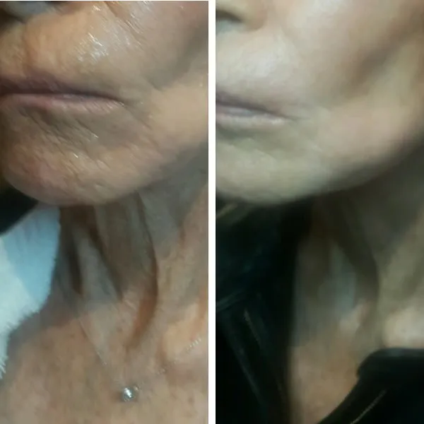 Before and after comparison of neck showing improved skin tightness and reduced creasing