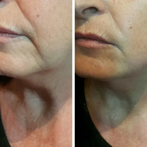 Before and after comparison of lower face and neck showing enhanced jawline definition and smoother texture