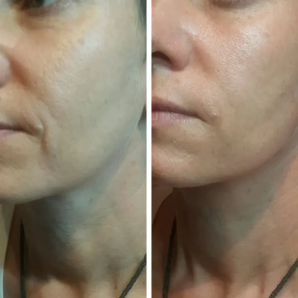Before and after comparison of lower face and neck showing improved skin firmness and reduced sagging