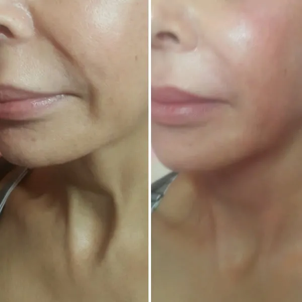 Before and after comparison of lower face and neck showing enhanced contour and smoother appearance