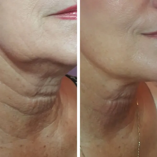 Before and after of lower face and neck showing reduced sagging and improved skin texture