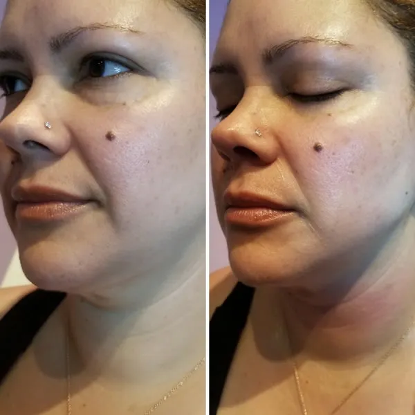 Before and after of woman's face showing reduced under-eye hollowing and improved cheek definition