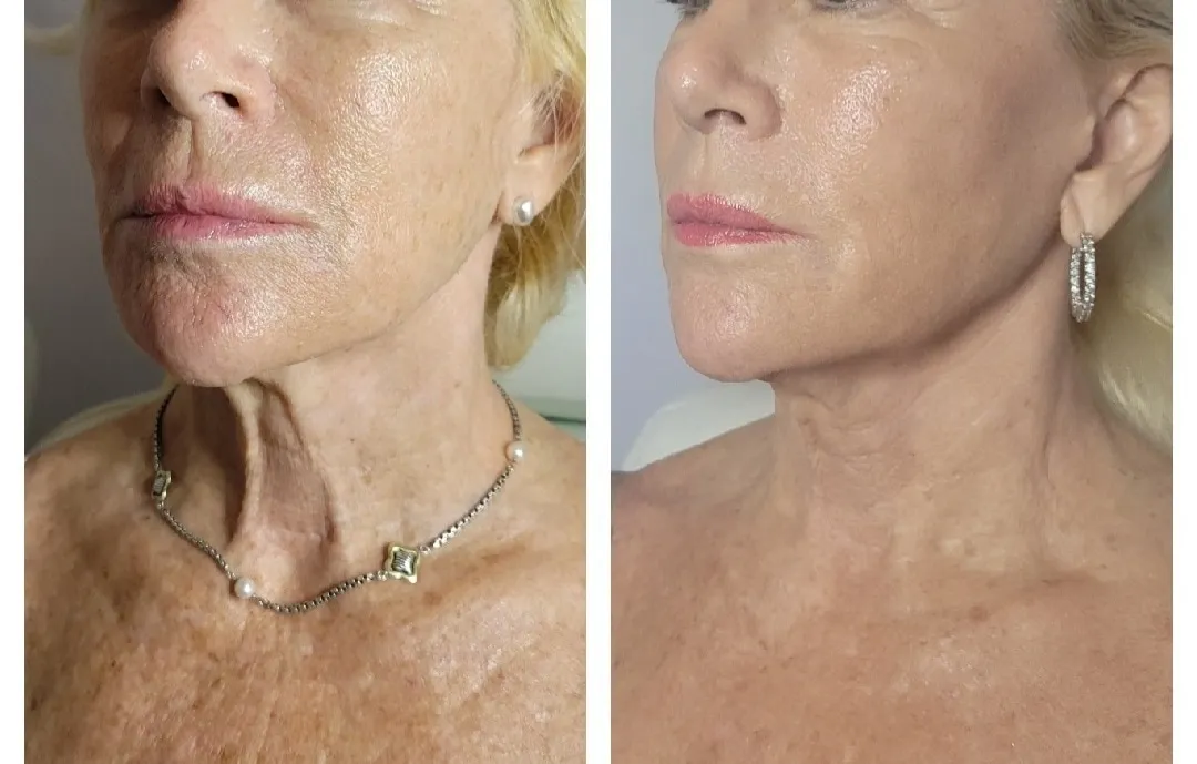 Face and neck-2