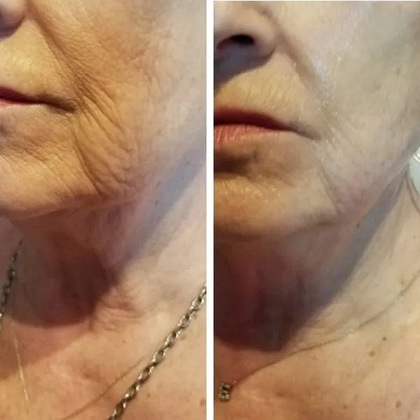 Before and after of woman's lower face and neck showing smoother skin texture and reduced wrinkles