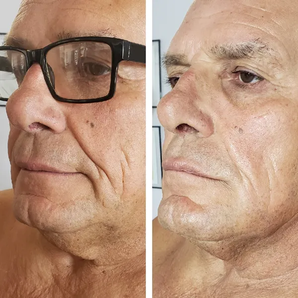 Face and neck-21