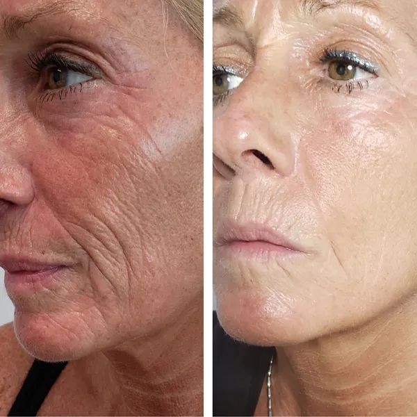 Before and after of woman's eye area and cheek showing improved skin texture and reduced fine lines
