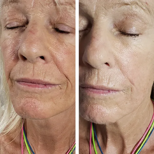 Before and after of woman's lower face and neck showing improved skin smoothness and reduced wrinkle depth