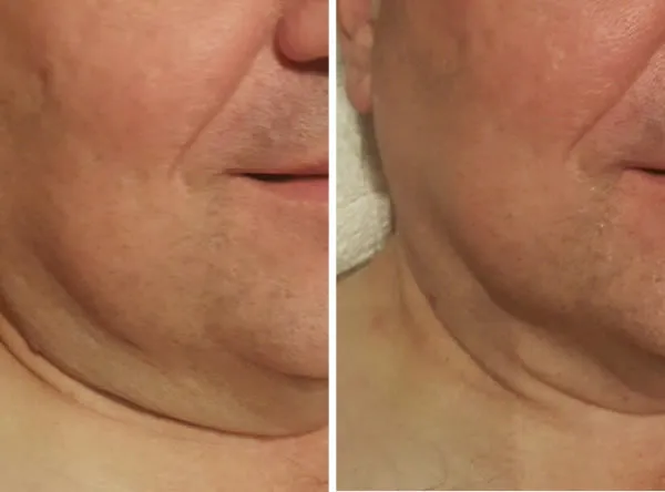 Before and after comparison of jawline and neck showing reduced sagging and improved definition