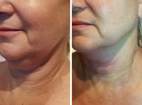 Before and after side profile of chin and neck showing improved contour and reduced laxity