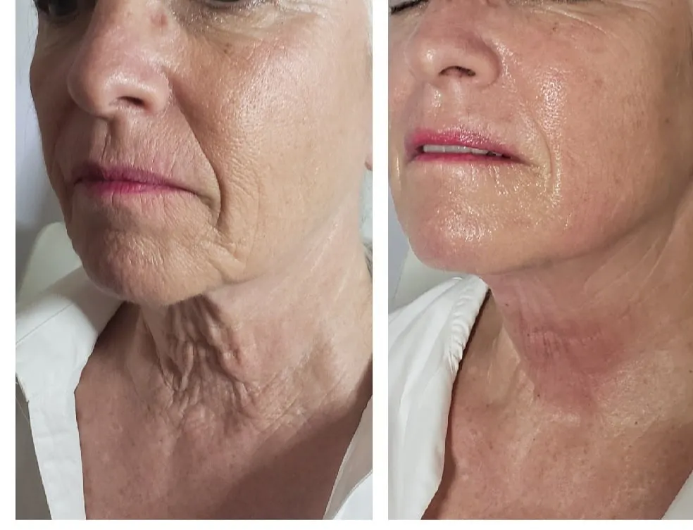 Before and after profile view of lower face and neck showing smoother skin texture and lifted appearance