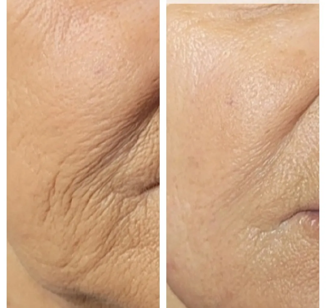 Before and after close-up of neck showing improved skin texture and reduced wrinkles